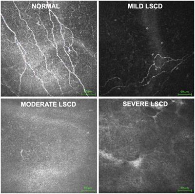 Latent diffusion augmentation enhances deep learning analysis of neuro-morphology in limbal stem cell deficiency